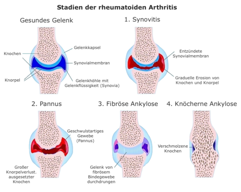 Symptome rheumatoide Arthritis